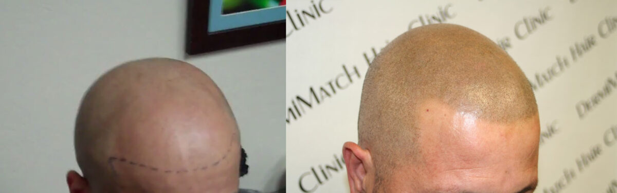 scalp micropigmentation SMP for thinning hair