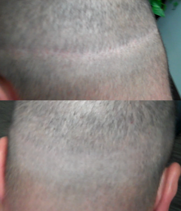 scalp micropigmentation smp in arizona