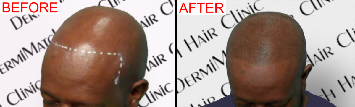 scalp micropigmentation SMP in Arizona