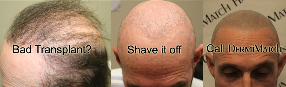 scalp micropigmentation smp in arizona