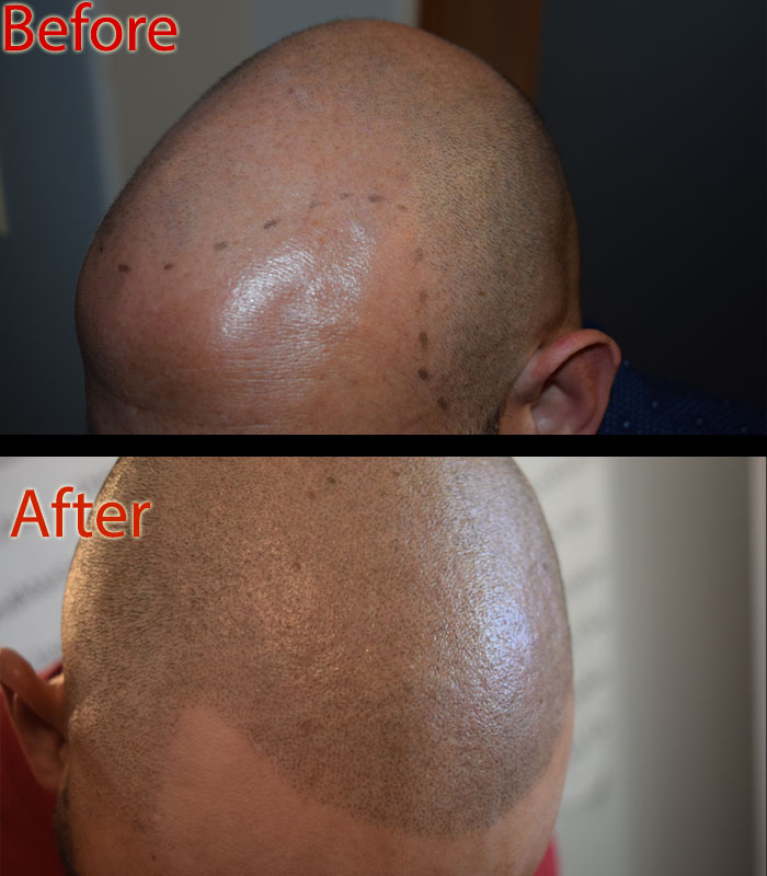 scalp micropigmentation SMP in Arizona