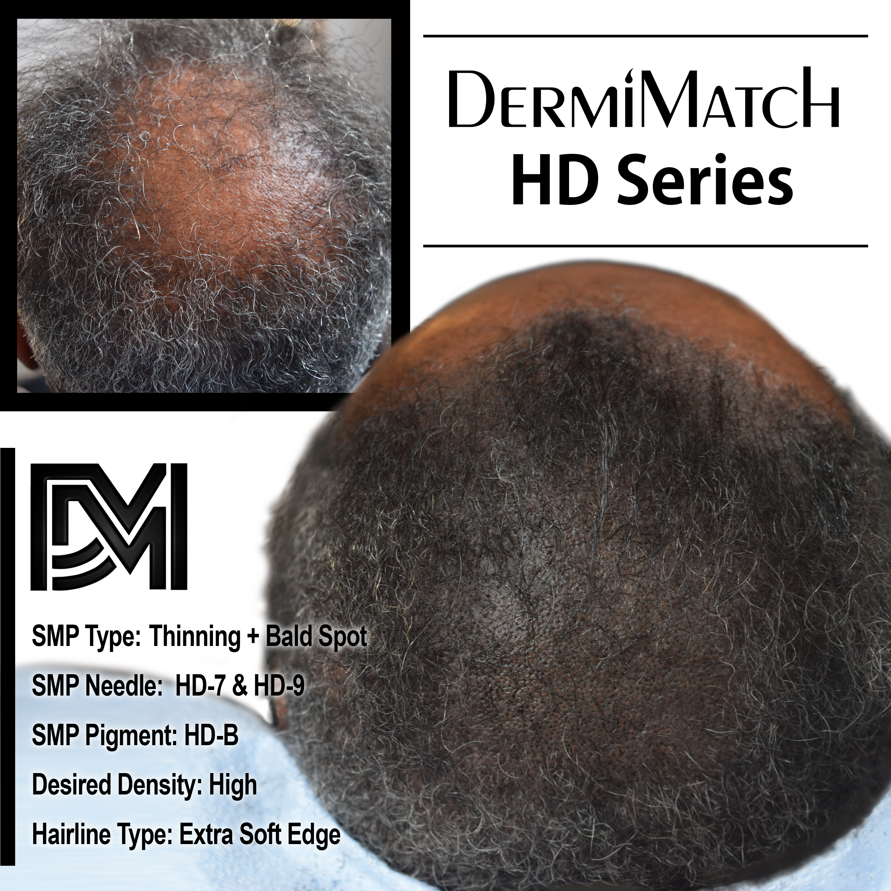 scalp micropigmentation SMP Arizona
