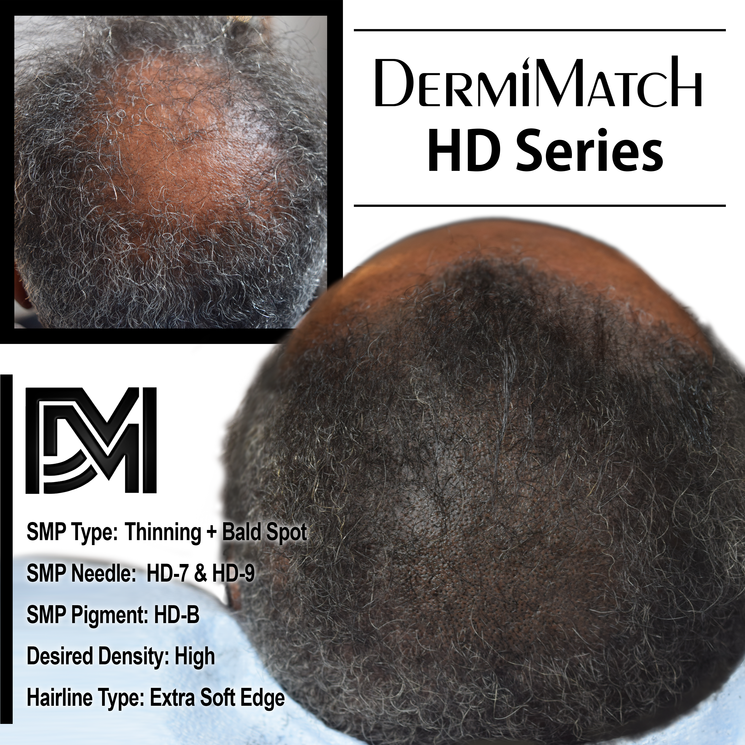 scalp micropigmentation SMP treatment in arizona