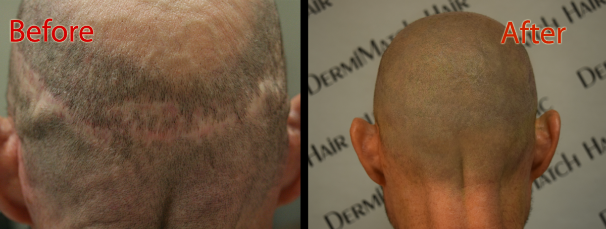 scalp micropigmentation smp arizona