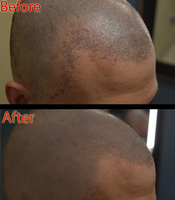 scalp micropigmentation smp for hair loss