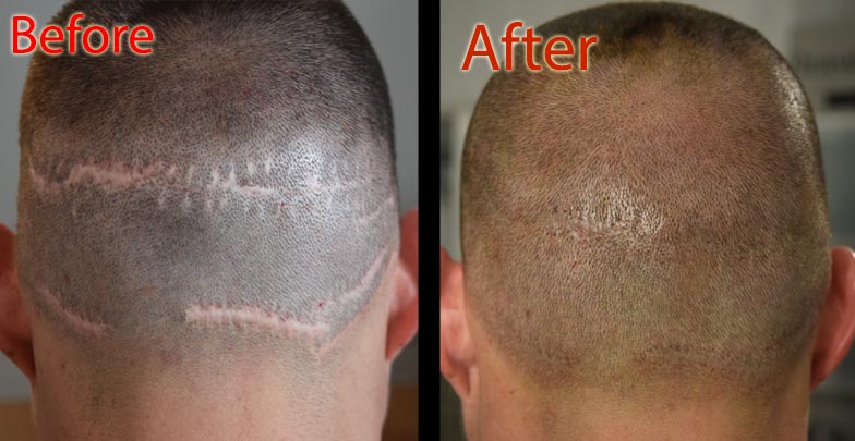 scalp micropigmentation smp arizona for dehydrated hair