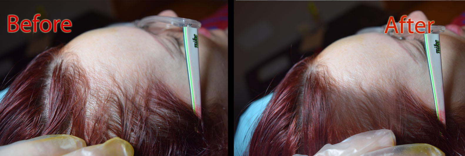 a woman suffering from gut dysbiosis seeks scalp micropigmentation smp arizona.