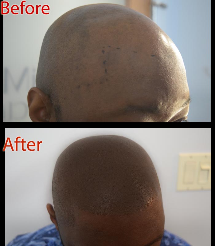 scalp micropigmentation SMP Arizona versus oral hair loss supplements