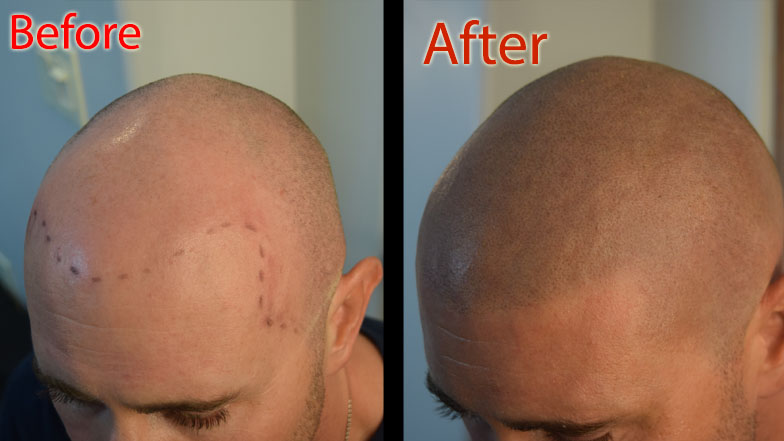 scalp micropigmentation smp Arizona