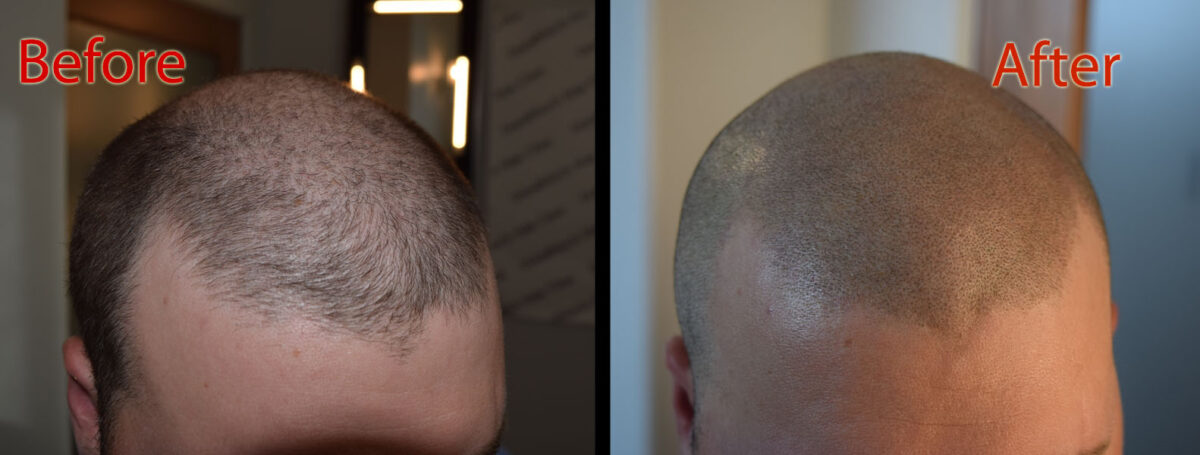 scalp micropigmentation smp arizona for scalp health