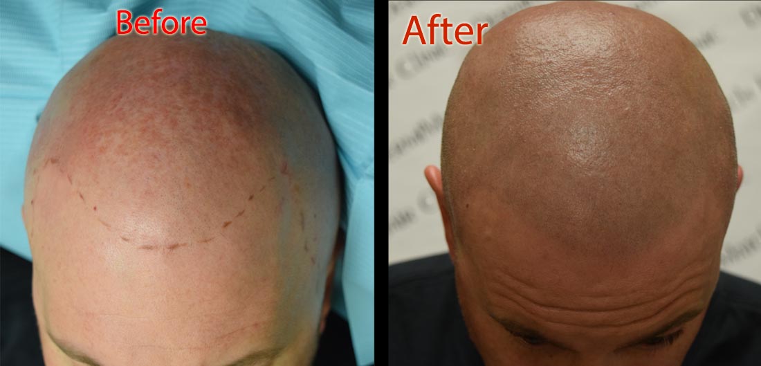 scalp micropigmentation smp arizona for nutritional hair loss