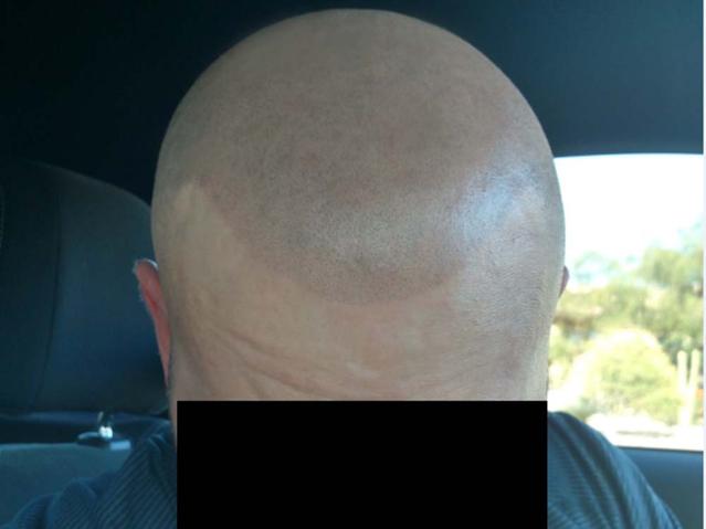 compare scalp micropigmentation smp arizona versus apple vinegar for hair.