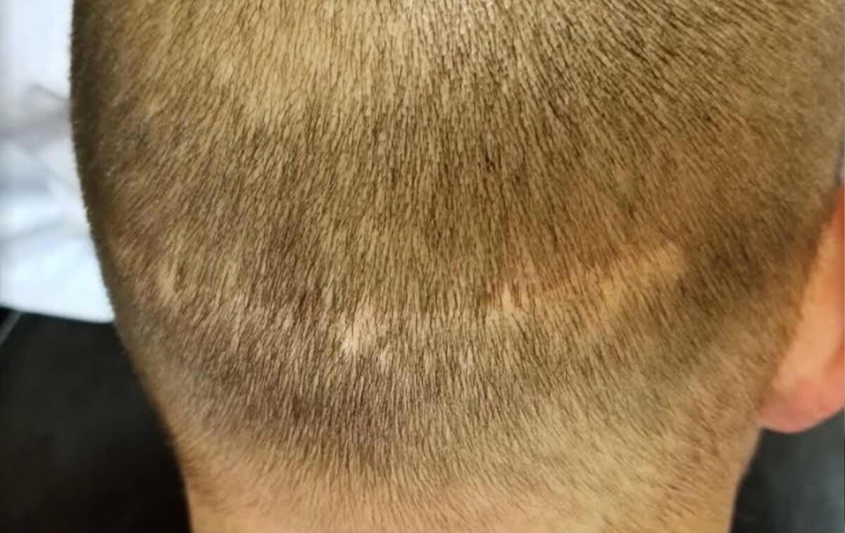 is scalp micropigmentation smp arizona the right scarring alopecia treatment?