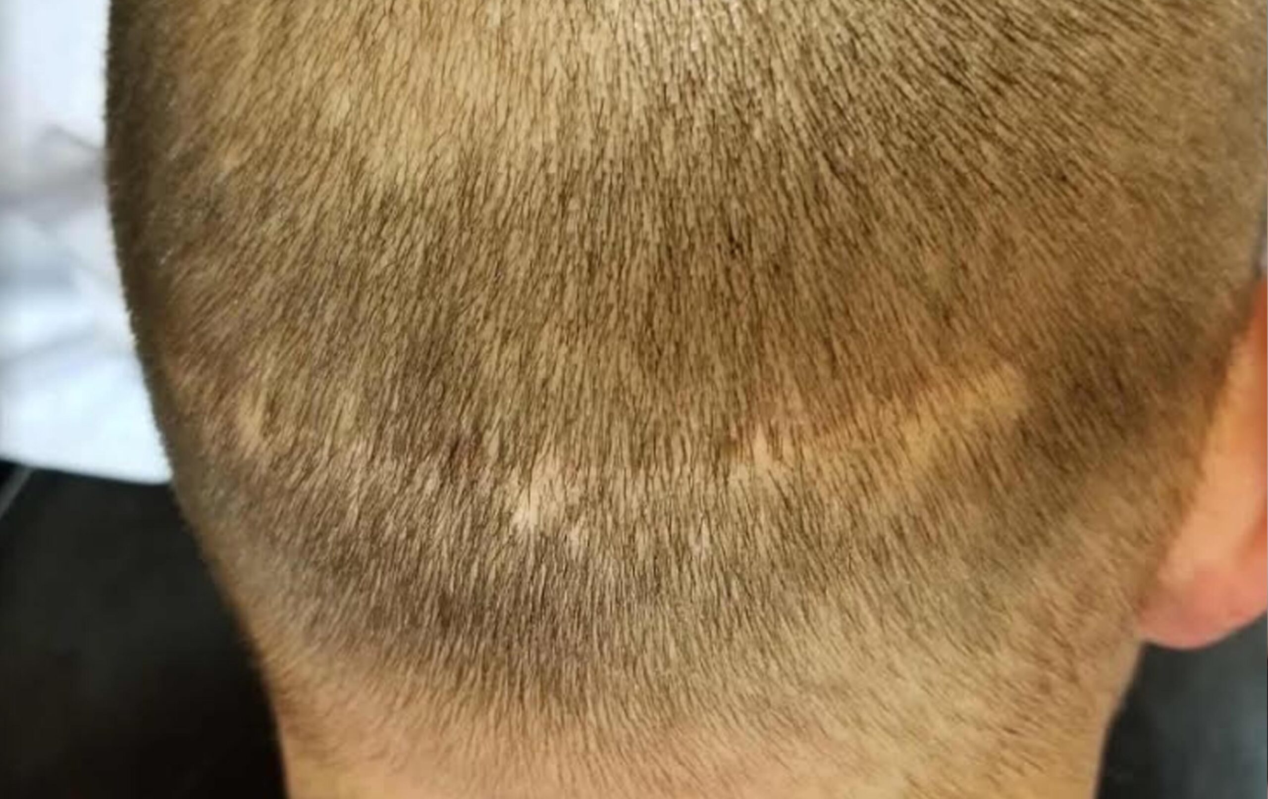 is scalp micropigmentation smp arizona the right scarring alopecia treatment?