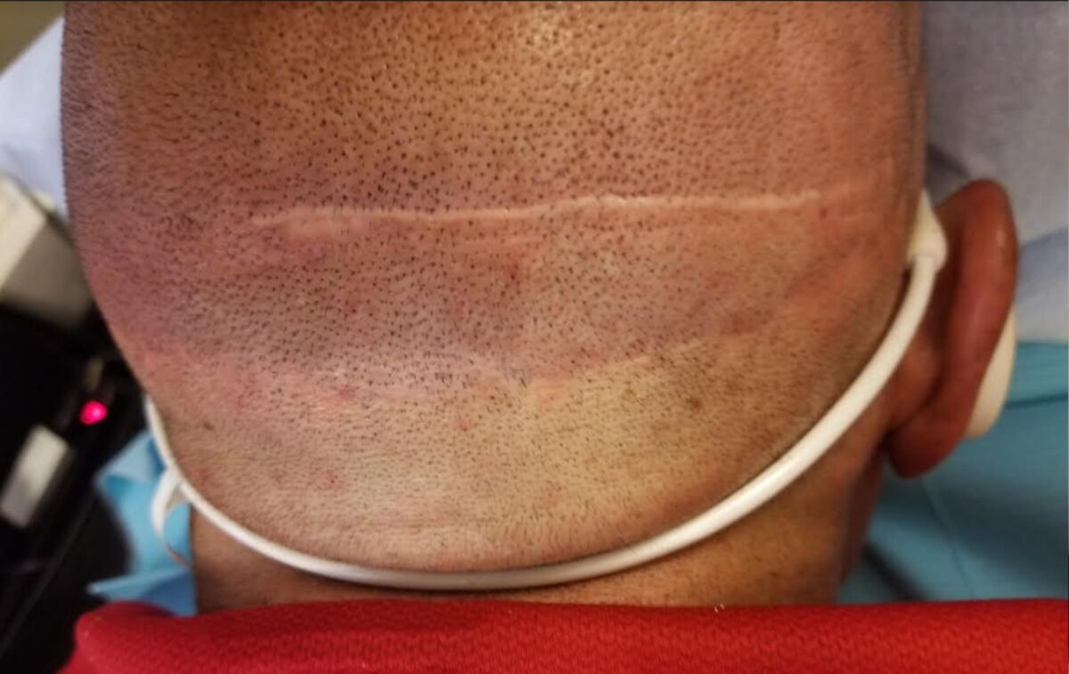 does SMP scalp micropigmentation Arizona help a strip scar?