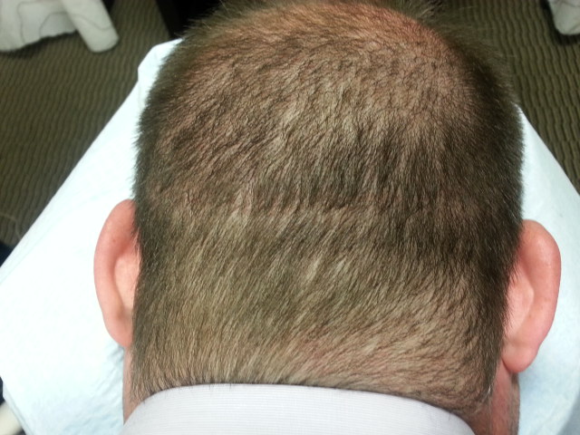 can scalp mcropigmentation smp arizona help this man with Trichotillomania?