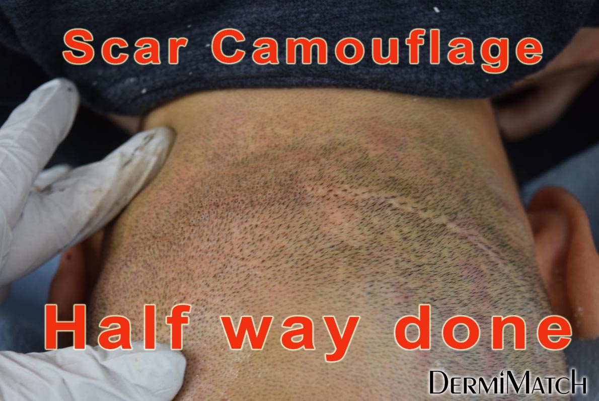does scalp micropigmentation smp arizona help burn scars?
