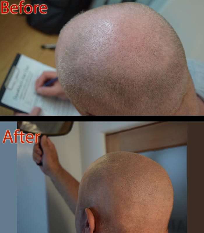 does scalp micropigmentation SMP Arizona for steroid hair loss work?